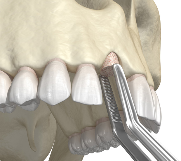 Boca Raton Bone Grafting for Dental Implants