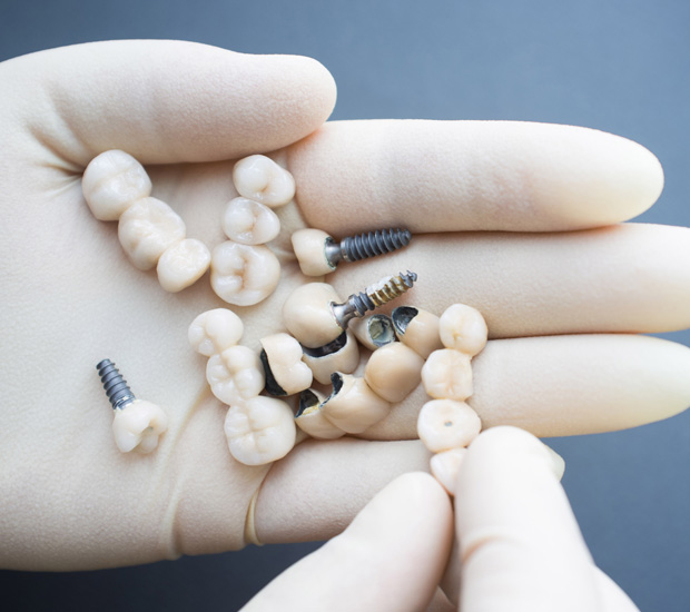 Boca Raton Crowns vs. Implants