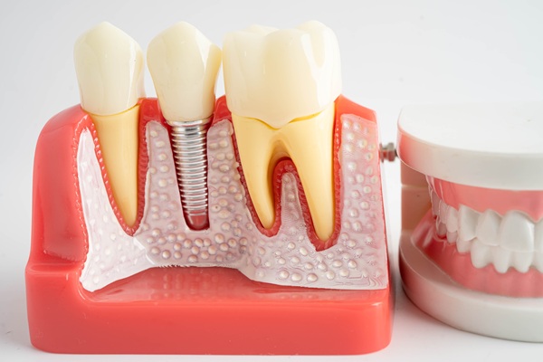 Dental Implant Recovery: What To Expect After The Procedure