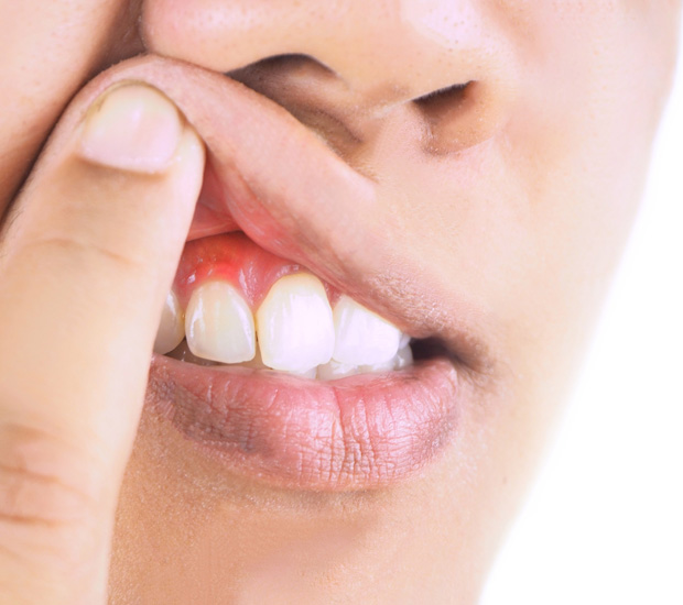 Boca Raton Gingivitis