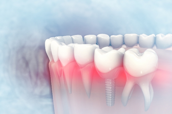 A Periodontist Addresses Common Concerns About Dental Implants
